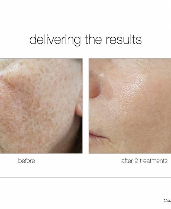 skin-before-after-facial-skin-resurfacing skin tightening radiant confidence medical aesthetic spa lapeer oxford