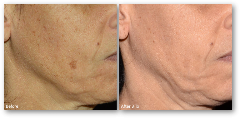 LaseMD Ultra before after hyperpigmentation age spots sun exposure burns medical aesthetic spa oxford