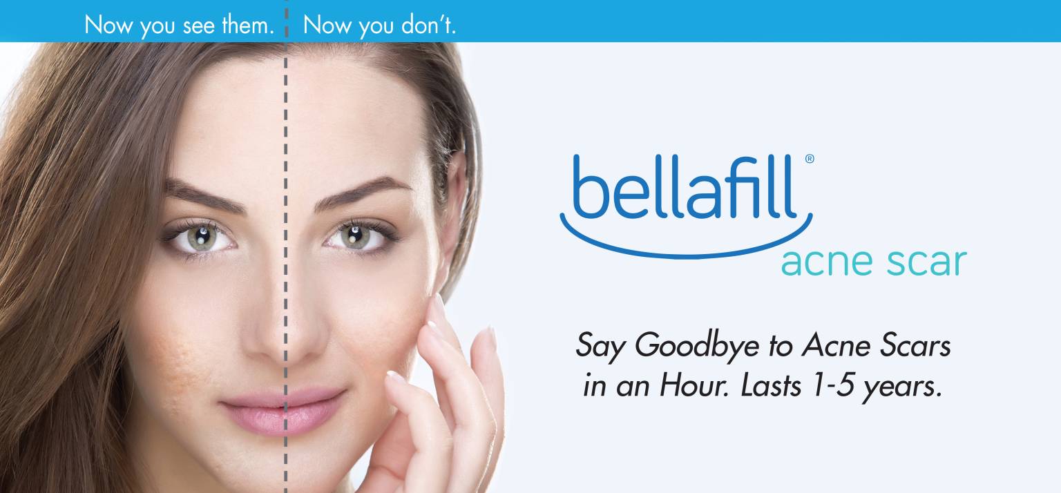 Bellafill ANewYouAestheticSpa