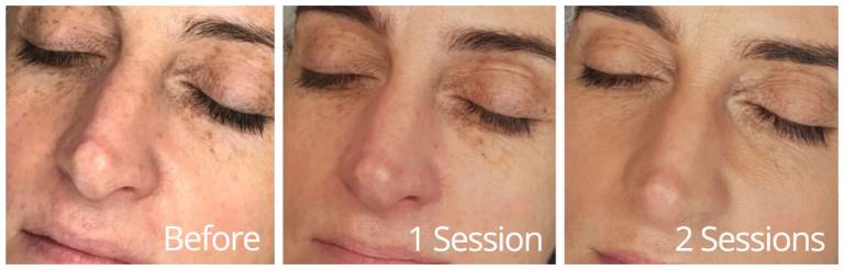 Venus Glow 3 images Facial Rejuvenation Medical Spa Aesthetic Oxford
