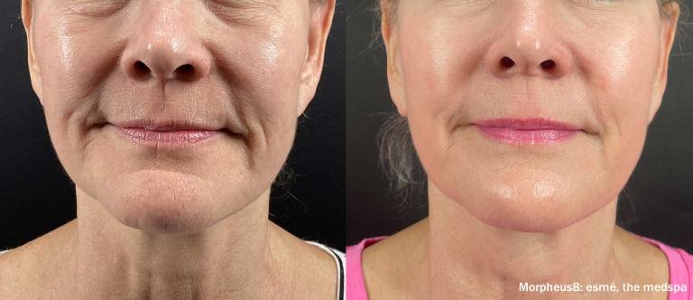 Morpheus8 Before after 4 treatments radio frequency microneedling skin resurfacing Front Medical Spa near me