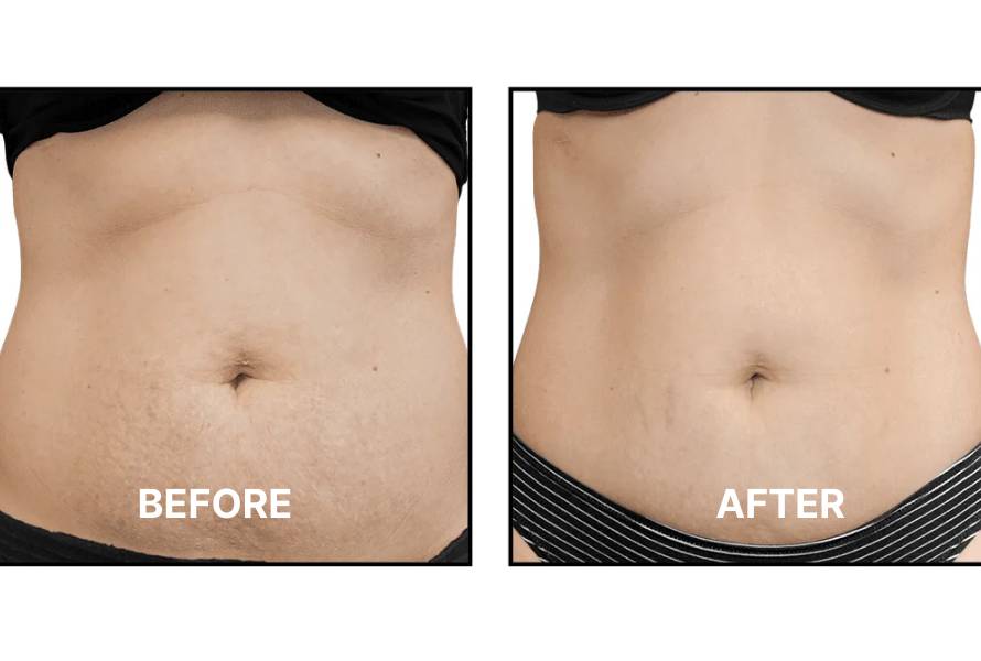 Morpheus8 Body Before After Skin Toned Non Invasive Fast Medical Aesthetic Spa Oxford