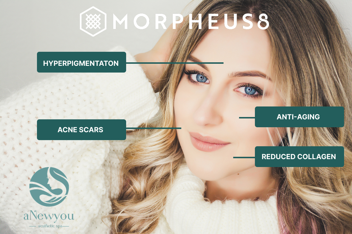 Morpheus8 Face Skin Hyperpigmentation Acne Scars Anti Aging Reduced Collagen Minimally Invasive Medical Spa Aesthetic Oxford