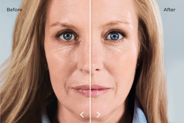 Sculptra Before After Woman Biostimulator Wrinkles Skin Facial Injections Medical Aesthetic Spa Lapeer Oxford