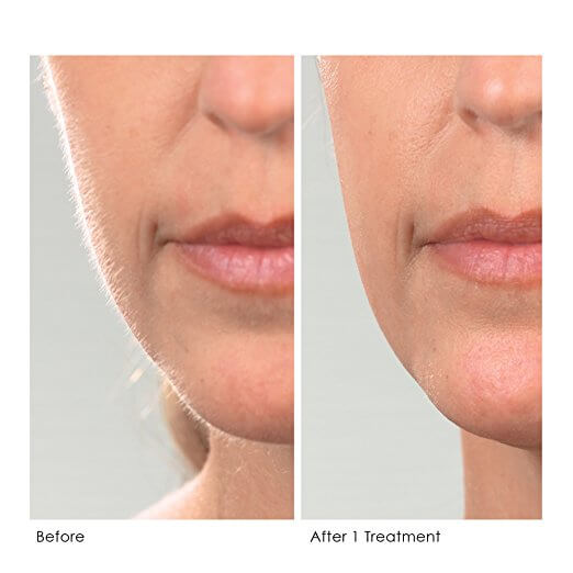 Dermaplaning Before And After Skin Rejuvenation Medical Aesthetic Spa Lapeer Oxford