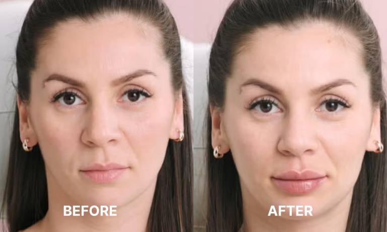 Lip Filler Before After Man Dermal Fillers Lapeer Oxford
