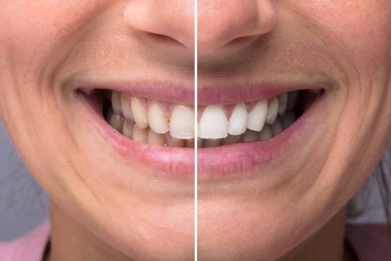 Teeth Whitening Before After Health Wellness Medical Aesthetic Spa Lapeer Oxford