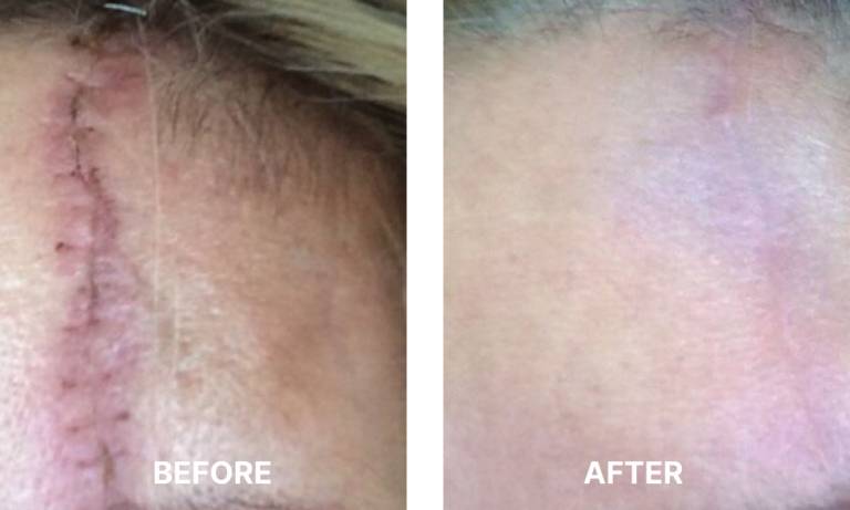 Venus Viva Md Body Contouring Before After Oxford