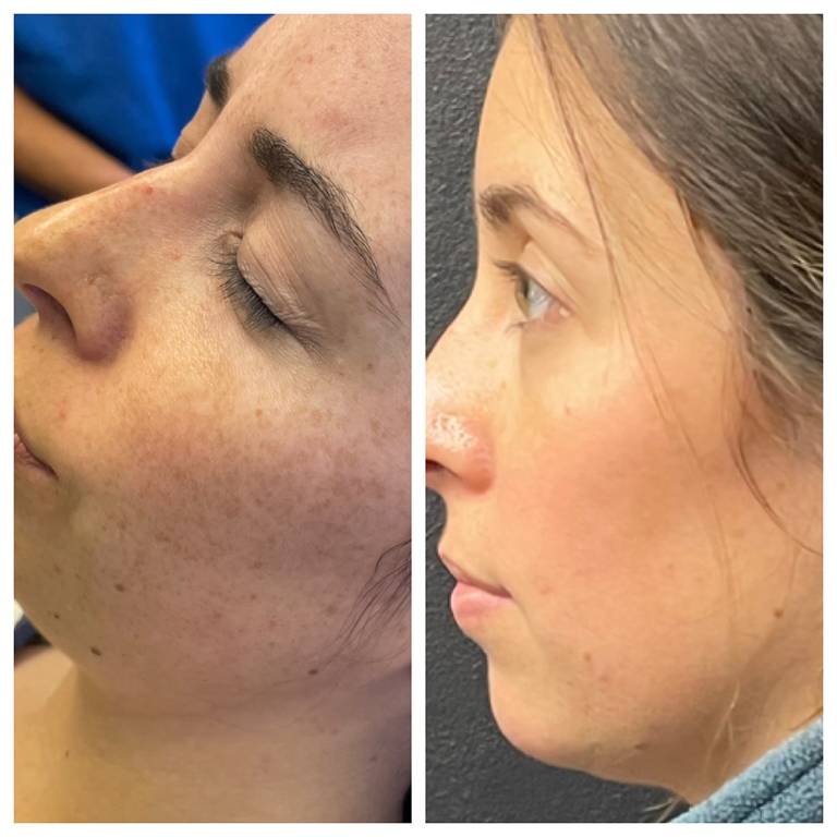 Chemical Peel before after julies medical aesthetic spa-near me