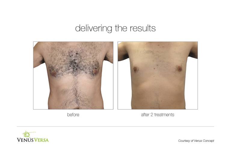 venus versa before after laser hair removal near me