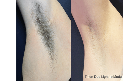Triton Laser Hair Removal Before And After Treatment Medical Aesthetic Spa Oxford