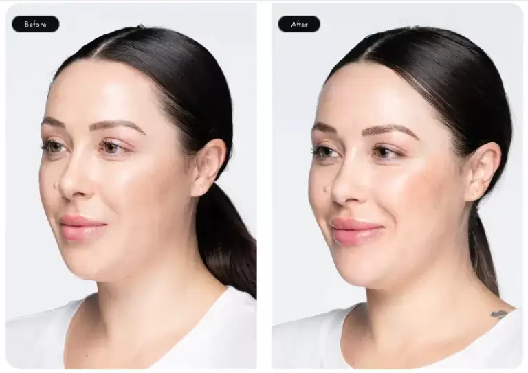 Revanesse Before And After Photo Examples 1